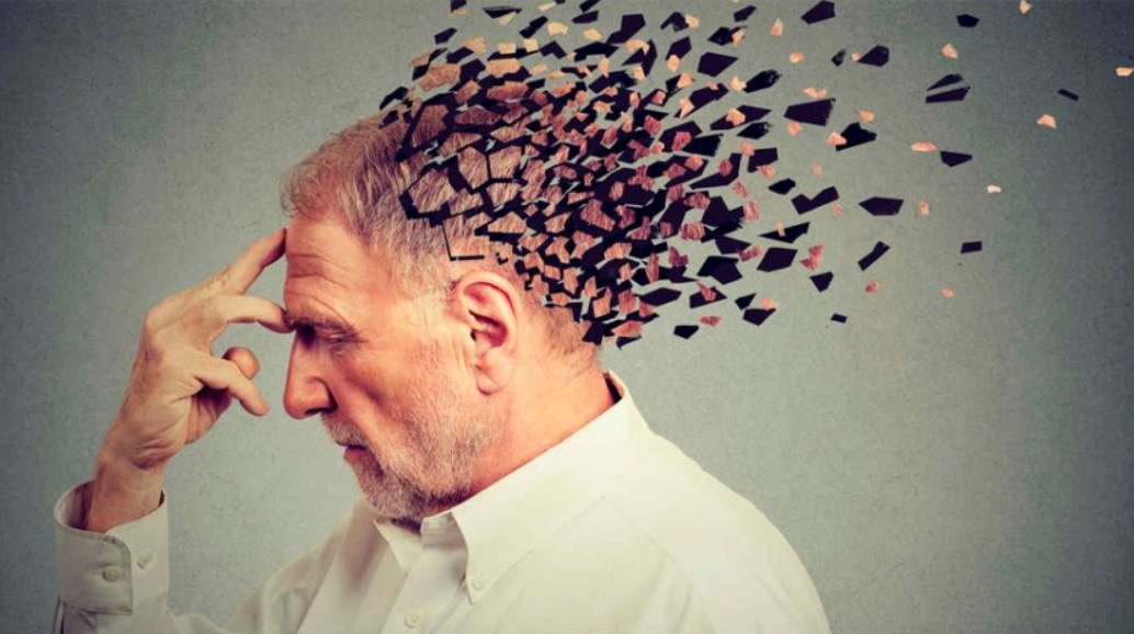 آلزایمر