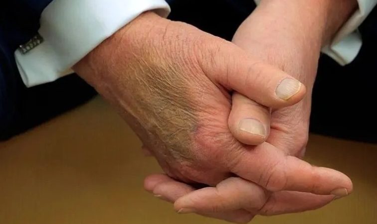 نام بیماری دونالد ترامپ فاش شد
