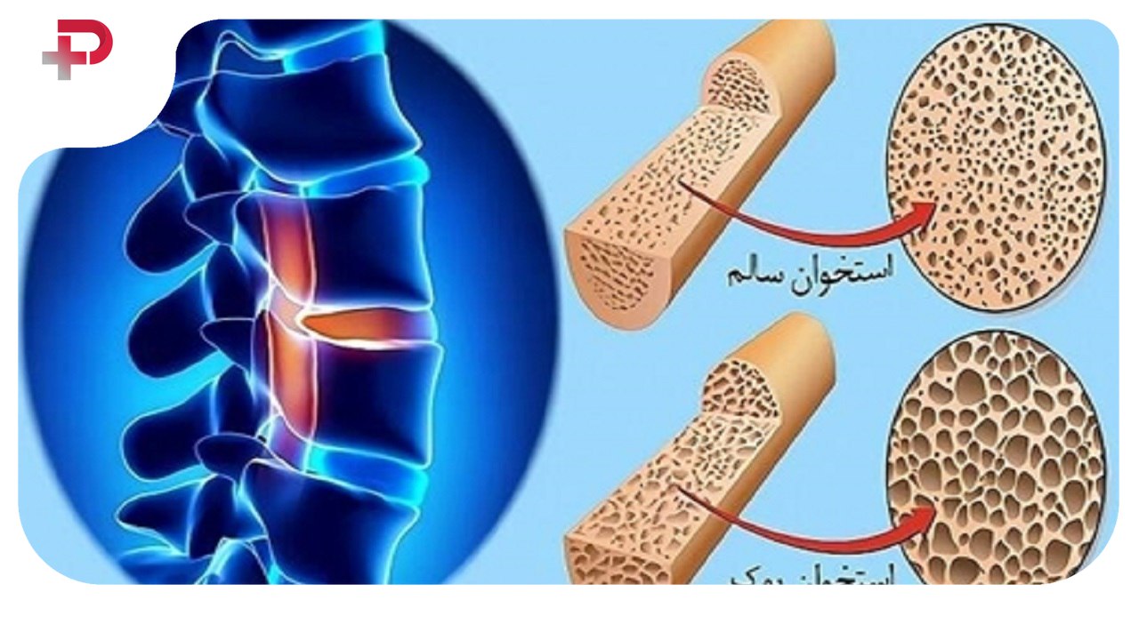 پوکی استخوان
