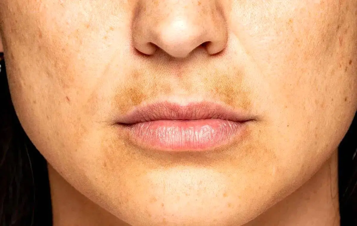 غذاهایی که راز پنهان لکه‌های صورت شما را فاش می‌کنند! - تصویر شاخص