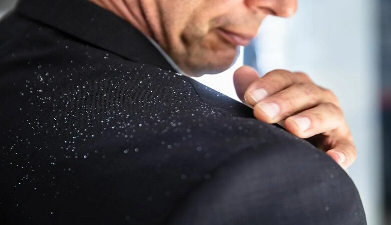پوستهپوسته شدن کف سر؛ چرا رخ میدهد و چطور از شرش خلاص شویم؟