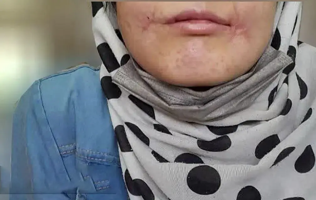 شوهر معتاد لبهای همسر ۱۸ سالهاش را با نخ و سوزن دوخت