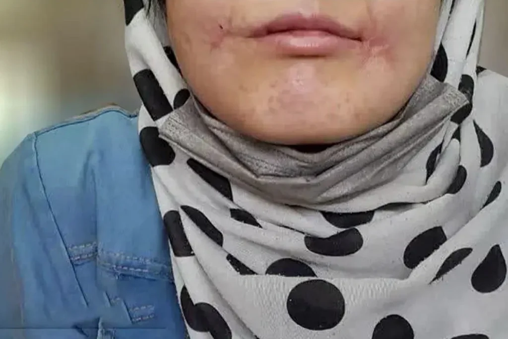 روایت تکان‌دهنده زن جوان از یک سال شکنجه در مشهد: شوهرش لب‌هایش را با نخ و سوزن دوخت! - تصویر شاخص