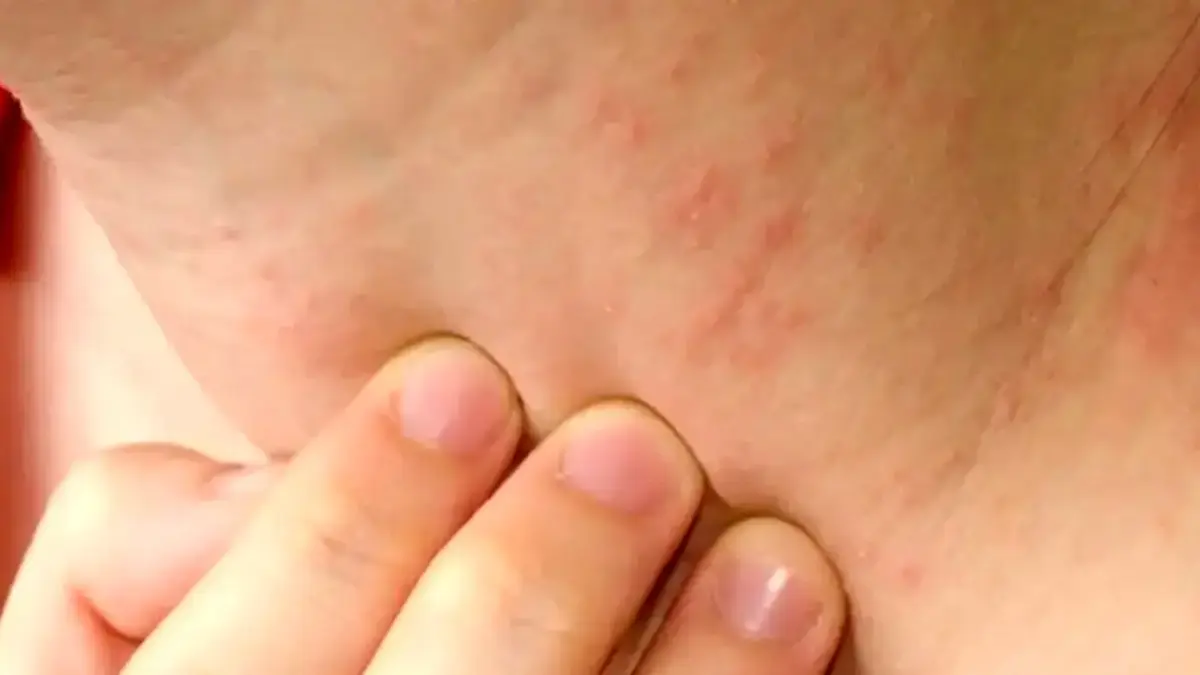 عرق‌ سوزی را دست‌کم نگیرید / اشتباهات ساده‌ای که التهاب پوست را تشدید می‌ کند