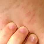 عرق‌ سوزی را دست‌کم نگیرید / اشتباهات ساده‌ای که التهاب پوست را تشدید می‌ کند